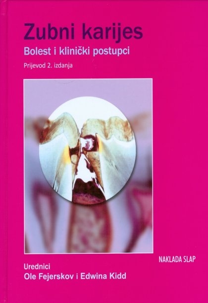 ZUBNI KARIJES: bolesti i klinički postupci